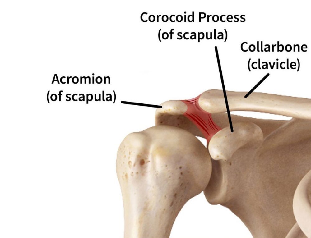 Sleeping with a Broken Collarbone Fracture Healing