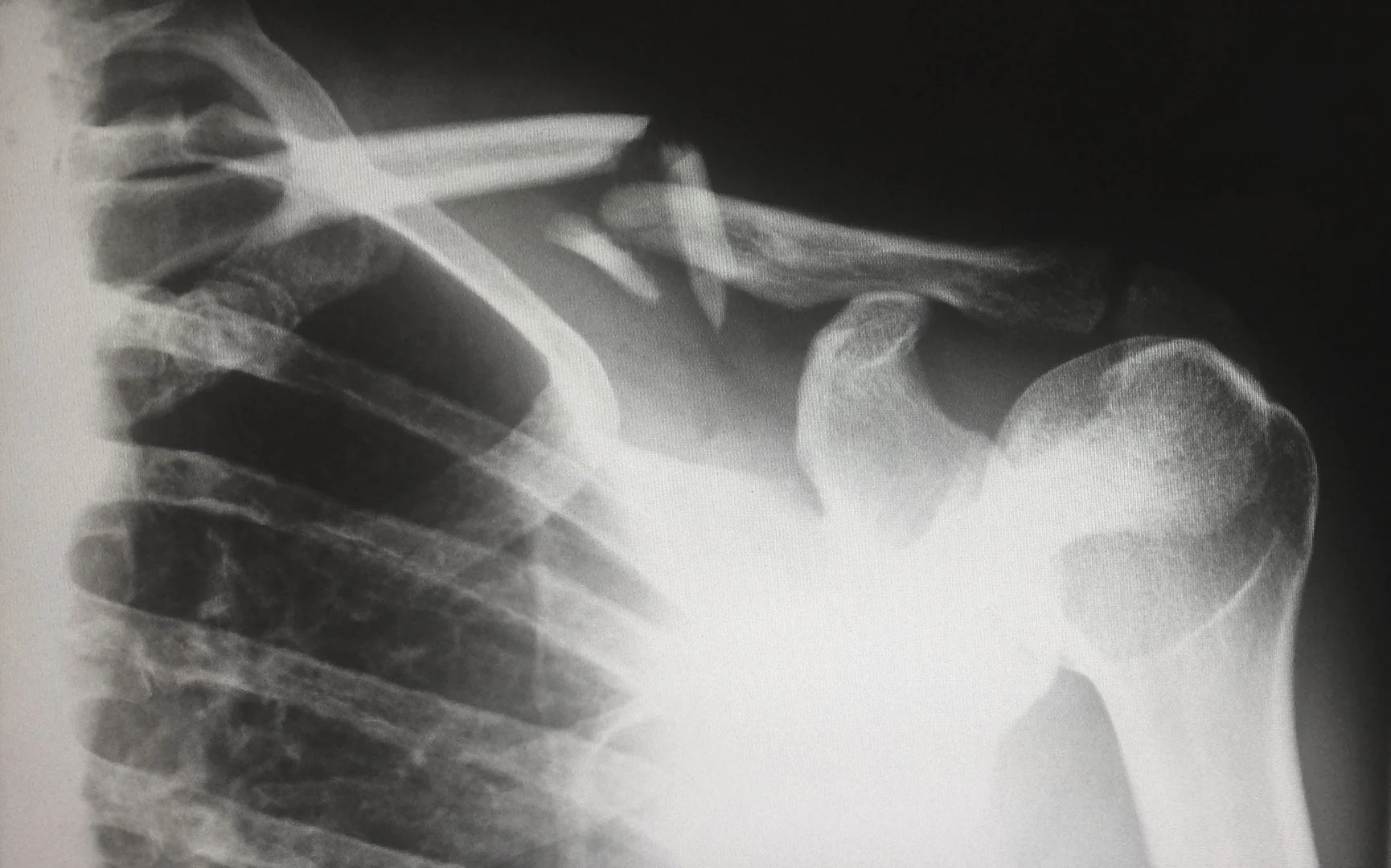 X-Ray Human Collarbone