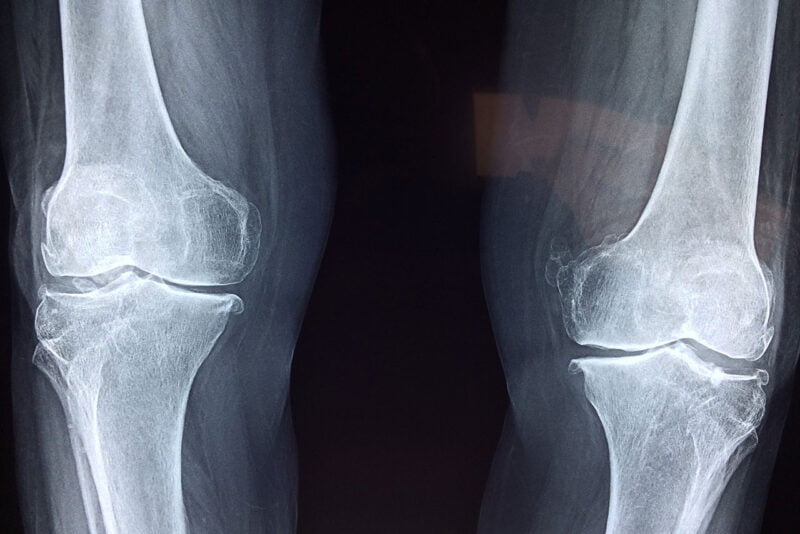 Can A Broken Bone Heal Without A Cast Fracture Healing