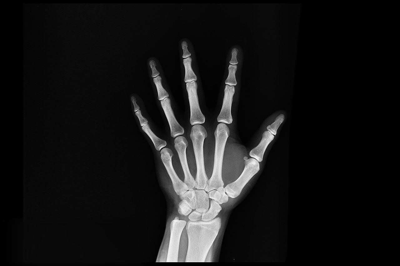 bone remodeling x ray