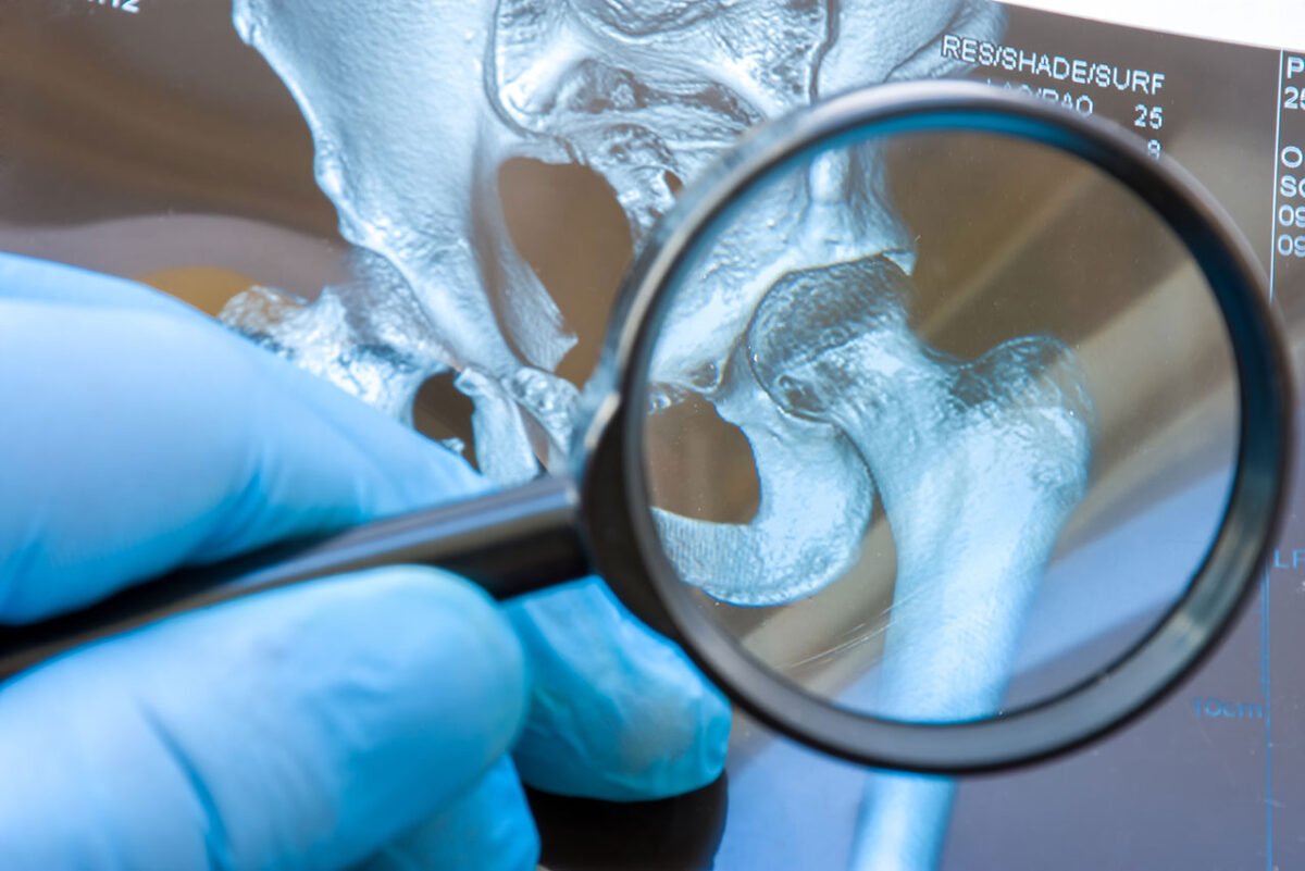 Avascular Necrosis (Osteonecrosis) - Symptoms, Causes and Risk Factors ...