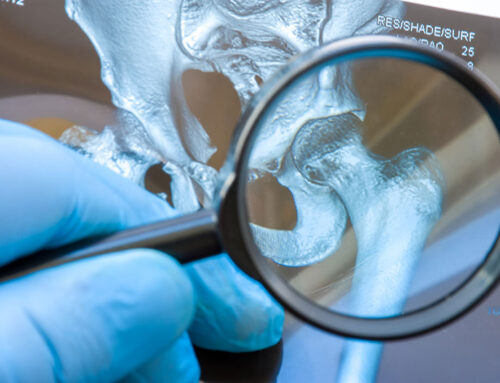Avascular Necrosis (Osteonecrosis) – Symptoms, Causes and Risk Factors