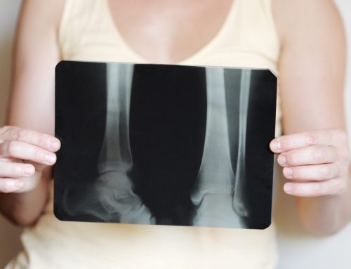 How Fractures Impact Bone Density Over Time