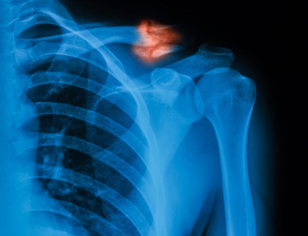 TENS Units - Fracture Healing