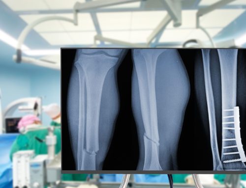 Comminuted Fractures: Can They Heal Without Surgery?